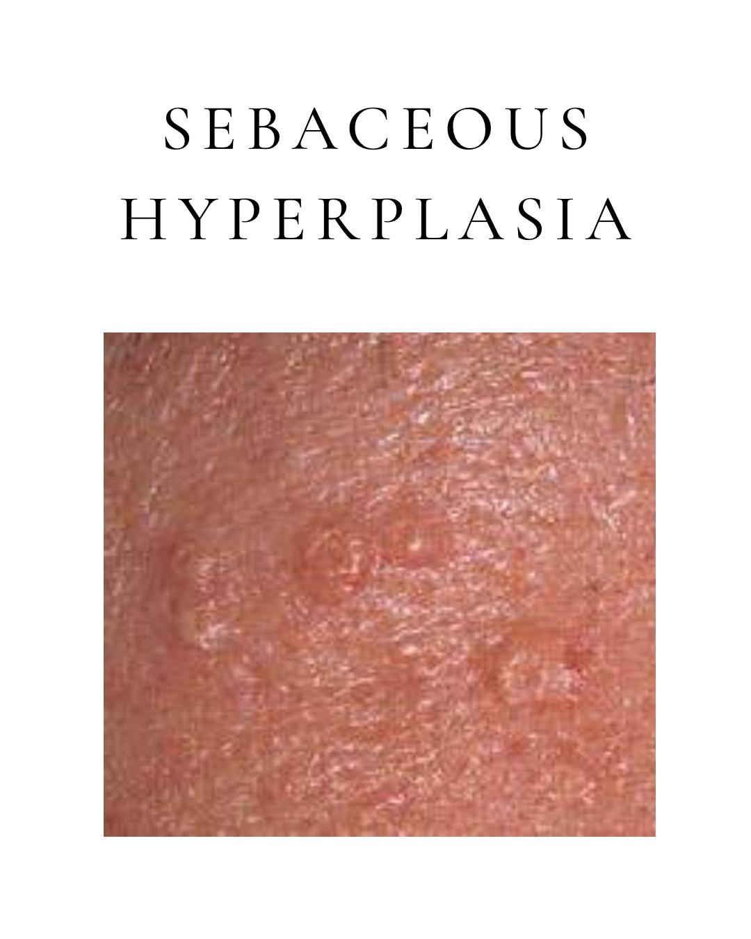 Sebaceous Hyperplasia